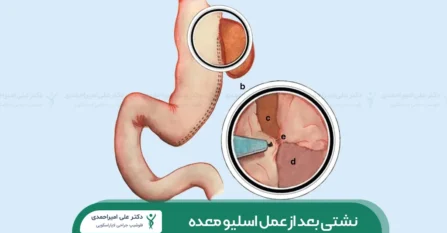 نشتی بعد از عمل اسلیو معده شاخص