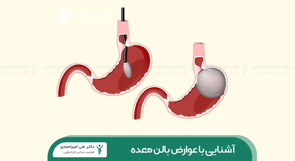 عوارض بالن معده شاخص