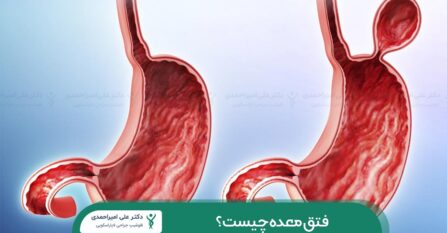فتق معده چیست؟