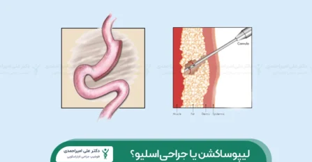 لیپوساکشن یا جراحی اسلیو شاخص
