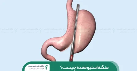 عکس منگنه اسلیو معده شاخص