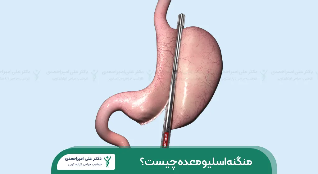 عکس منگنه اسلیو معده شاخص