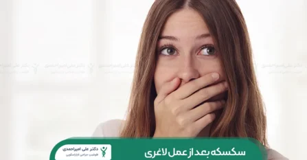 سکسکه بعد از عمل لاغری شاخص