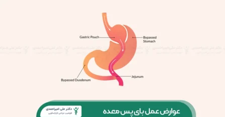 عوارض عمل بای پس معده شاخص
