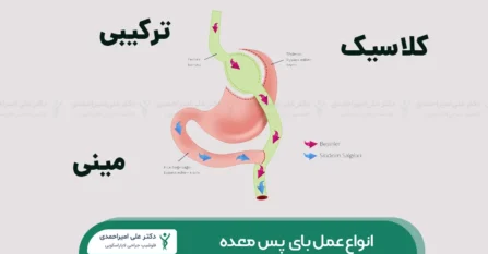 انواع عمل بای پس معده شاخص