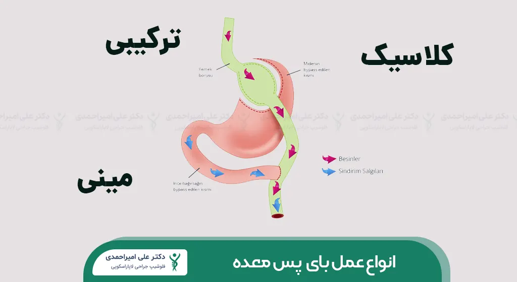 انواع عمل بای پس معده شاخص