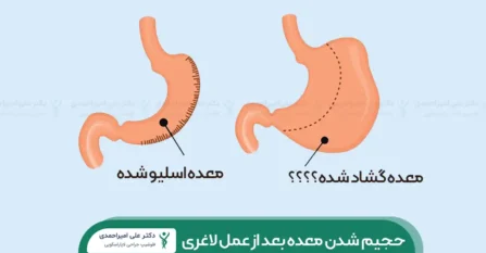 گشاد شدن معده بعد از عمل لاغری شاخص