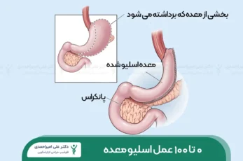 عمل اسلیو معده شاخص