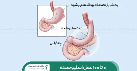عمل اسلیو معده شاخص