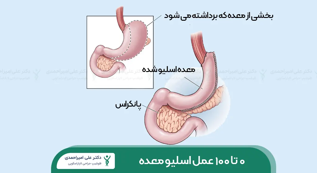 عمل اسلیو معده شاخص